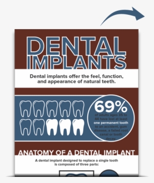 Dental Implants - Free Download - Infographic Implants #3674307