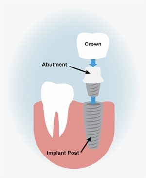 Dental Implants Graphic #373160 Dental Implants Graphic #373160