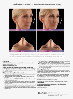 Tami Web-voluma - Injectable Filler #3706034