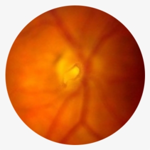 Flashes-floaters - Macular Degeneration #3752869