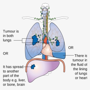 Negative Effects Of Smoking - Does Asbestos Affect The Lungs #3778345