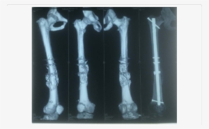 3d Ct Scan And X-ray Of Femur With Accelerated Union - Bone Fracture #3797225