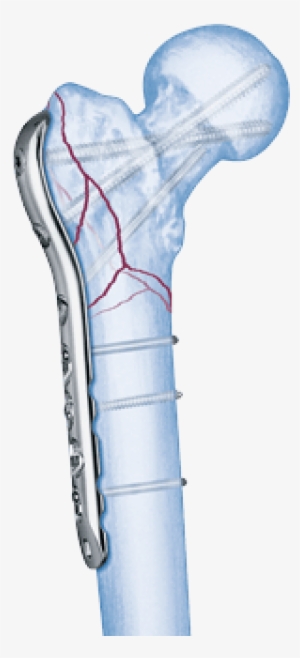 Choose - Femur Reverse Distal Lcp #3797250