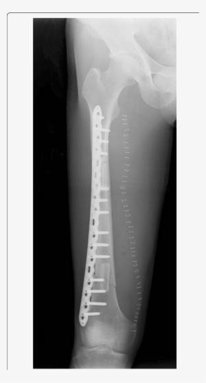 Postoperative Radiography After The Femur Reconstruction - X-ray #3797405
