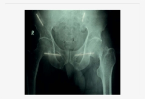Showing The Trans-cervical Fracture Neck Of Femur Left - Orthopedic Surgery #3797654