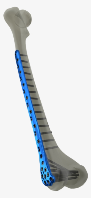 Distal Femur Locking Plate - Locking Plate Distal Femur #3797672