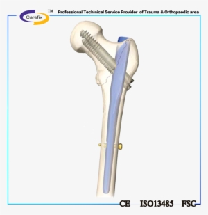 Carefix Femur And Tibia Interlocking Nail,metallic - Orthopaedic Femoral Surgery #3797902
