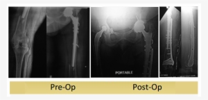 Left Periprosthetic Femur Fracture Operated By Dr Dshekhar - Radiology #3798194