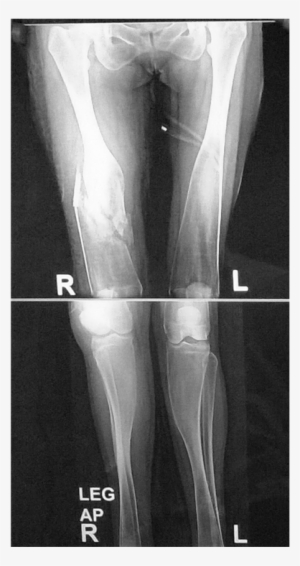 36 Years Old Female Patient Radiography Of Both Knee - X-ray - Free ...