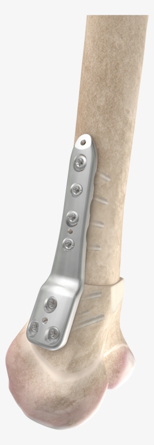 The Dfos System Includes Implants To Correct Several #3798717