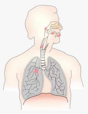 Cancer Caused By Smoking Png Images - Imagenes De Bradipnea #3847585