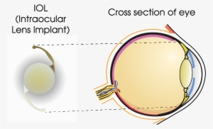 The Iol Acts As A Total Replacement For Your Natural - Portable Network Graphics #3856461