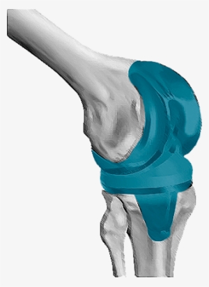 It Consists Of Removing The Damaged Cartilage And Bone - Germany #3885152