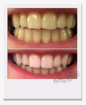 Pearly Whites Pro Kit Before And After Photo - Pearly Whites #3889282