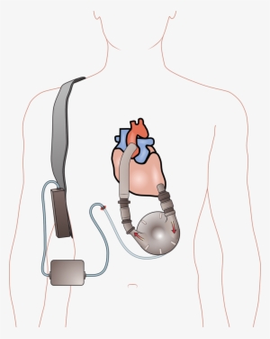 Aparato De Asistencia Ventricular #3894090