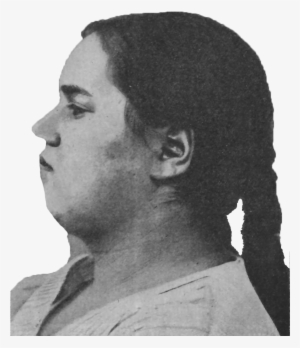 Schizophrenic Pubertial Weak-mindedness And Obesity, - Wikimedia Commons #3919011