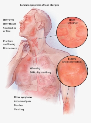 Allergy Download Transparent Png Image - Food Allergy Symptoms #3919912