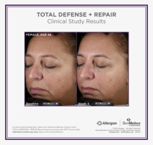 Tdr Before And After Gallery - Skinmedica H5 Before And After #3928397
