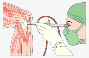 Arthroscopy-2607439 340 - Long Does It Take For Recovery After Knee Surgery #3938936
