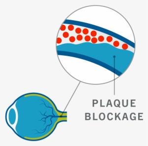 Veins In The Retina Become Blocked, Restricting Normal - Circle #3954905