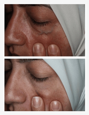 Facial Veins And Treatments - Sad #3955013