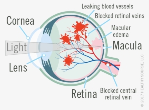 Diagram Of Eye Shows Cornea, Lens, Macula And Retina, - Diagram #3955307