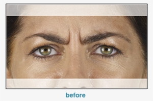 Injectable Filler #3955588