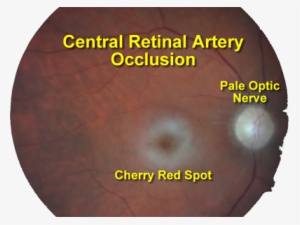 The Circulation To The Retina Enters The Eye Through - Occlusion Of ...