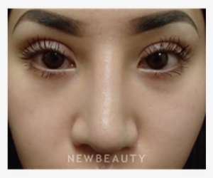 Dr Peter Chang Upper Blepharoplasty B - Blepharoplasty #3958964 Dr Peter Chang Upper Blepharoplasty B - Blepharoplasty #3958964