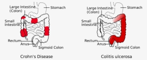 Open - Difference Between Crohns And Ulcerative Colitis #3975635