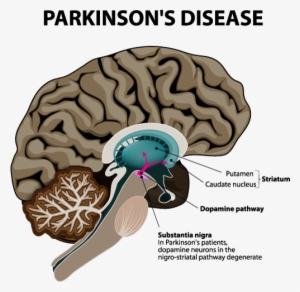 Parkinsons-pic - Parkinson's Disease Png #3975658