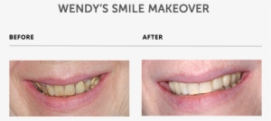 Weybridge Teeth Smile Makeover - Teeth Makeover #3977867