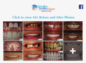 Express Teeth In A Day All On - Facebook #3977888