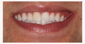 Partway - Tooth Bleaching #3977934