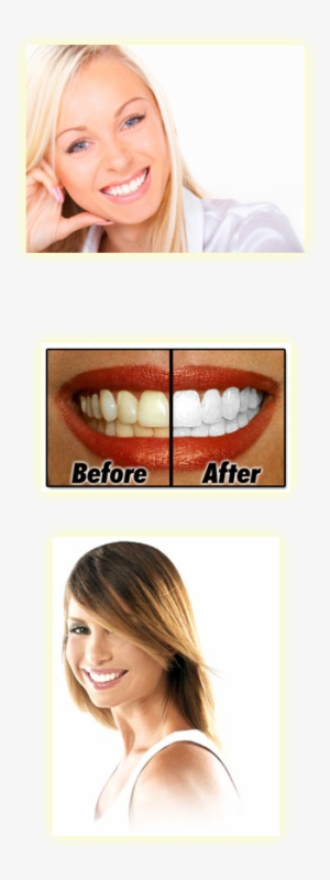 Teeth Whitening Is Perhaps The Most Common Cosmetic #3978129
