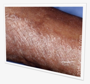 Foot Fungus - Bronze #3986351