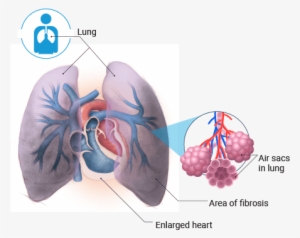 Pulmonary Fibrosis PNG, Transparent Pulmonary Fibrosis PNG Image Free ...