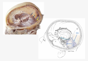 The Tentorial Incisura , - Cerebellar Tentorium #4021494