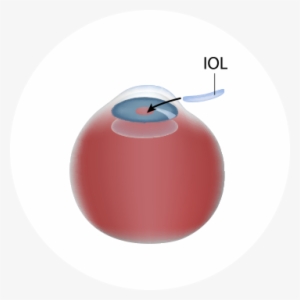 La Meta Con Las Cirugías De Catarata Y Uso De Lio Es - Circle #4022593