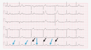Conduction Ecg - Handwriting #4040637 Conduction Ecg - Handwriting #4040637