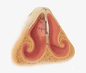 Perforated Septum Image - Nasal Septum #4061870