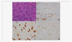 A Mononuclear Hodgkin Cells And Mutinucleated Reed-sternberg - Pattern #4069555