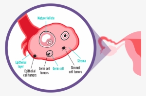 Epithelial Ovarian Carcinoma - Cell #4080277