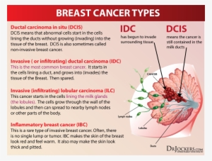 On The Other Hand, 20 To 30% Of Breast Cancer Cancers - Types Of Breast Cancer #4080671