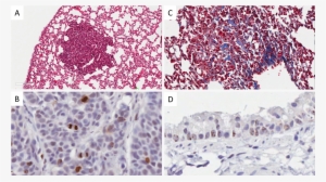 Lung Cancer Cell Proliferation Measured By Phospho - Normal Lung Tissue Vs Lung Cancer #4081202