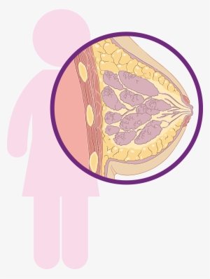 La Mayoría Son Carcinomas, Tipo De Cáncer Que Comienza - Breast Cancer #4085001