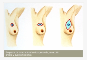 Puede Ser La Mastectomía Simple , En La Cual Se Remueve - Radioterapia Neoadyuvante #4086064
