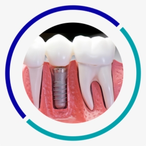 Dental Implants #4092223