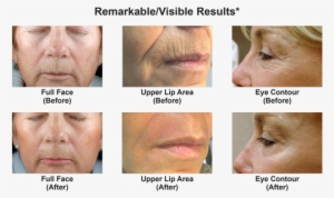 What Can Dot Co2 Therapy Do For Me - Collage #4103026