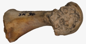 1st Metatarsal With Lesions Caused By Gout - Tool #4106120